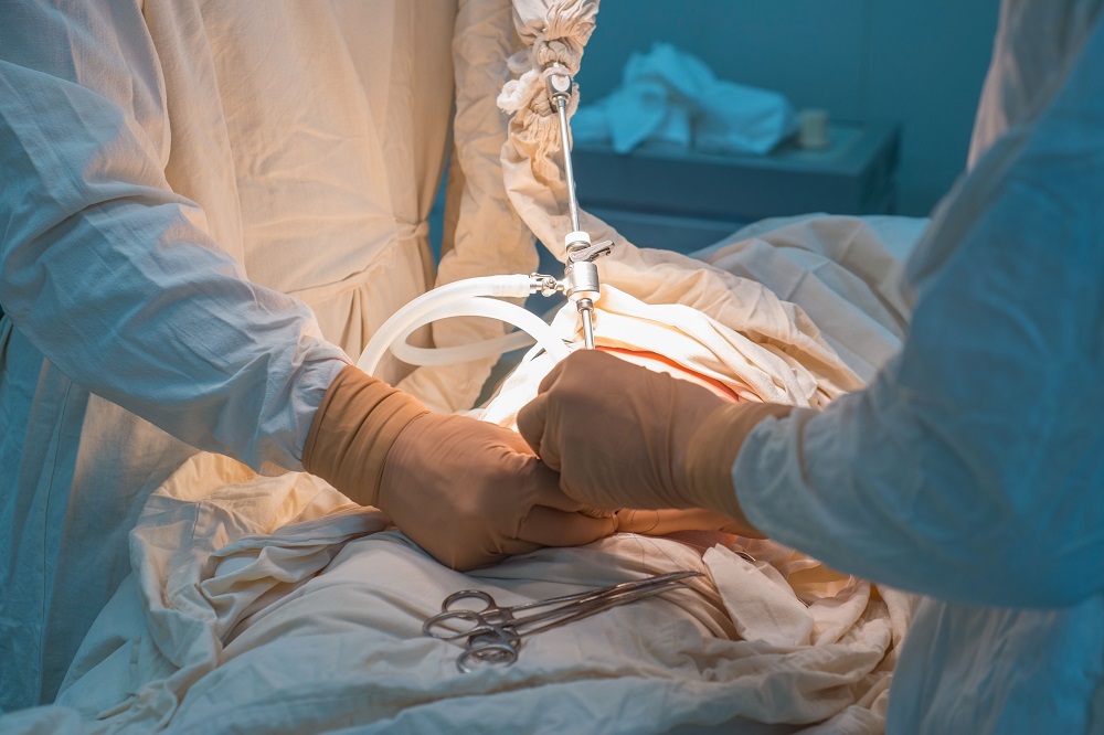 How Gastric Bypass Can Support Long-Term Weight Loss